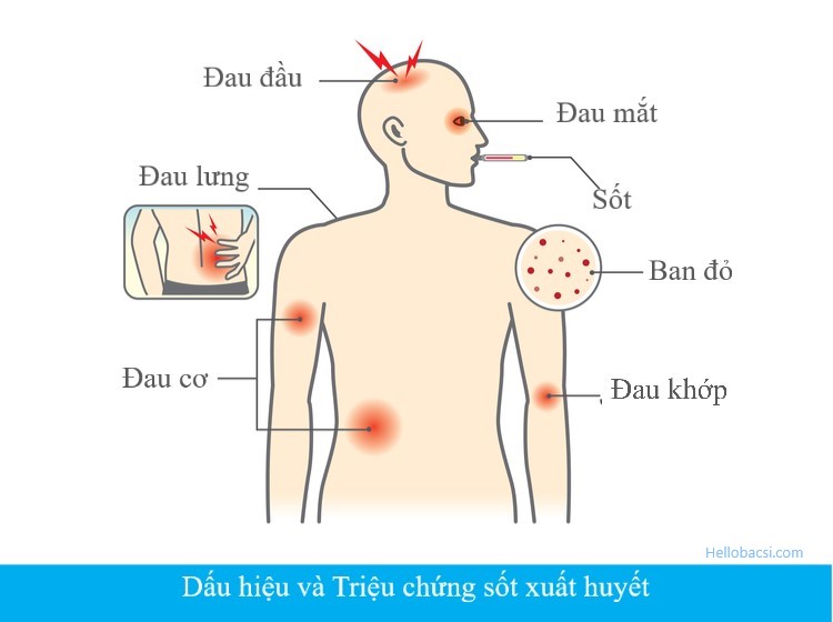 TRIỆU CHỨNG SỐT XUẤT HUYẾT